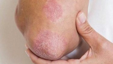 Realizarán una campaña gratuita de detección de psoriasis en Neuquén