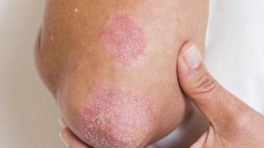 La campaña es en septiembre pero antes es necesario solicitar turnos. (Gentileza)