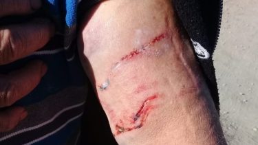 Otro brutal ataque de perros en Bariloche