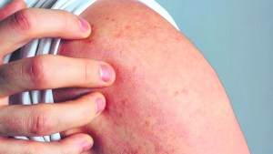 Harán chequeos gratuitos de lunares en el centro de Neuquén desde hoy y hasta el sábado