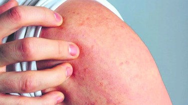 La acción en Neuquén, forma parte de una medida para prevenir el cáncer de piel. Foto: Archivo