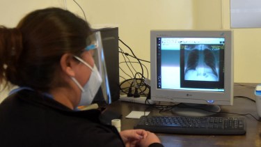 Qué les pasa a los pulmones durante y después del COVID-19