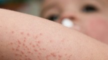 Imagen de Día Mundial de la Dermatitis Atópica: entre un 15 y 30% de niños y niñas la padecen