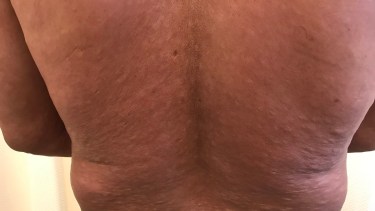 Las marcas de la enfermedad de la lepra se evidencian en la piel. Gentileza