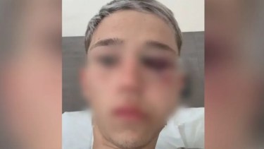 El adolescente golpeado tiene un pómulo destrozado. 