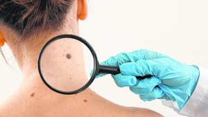 Un científico argentino desarrolló una vacuna contra el cáncer de piel