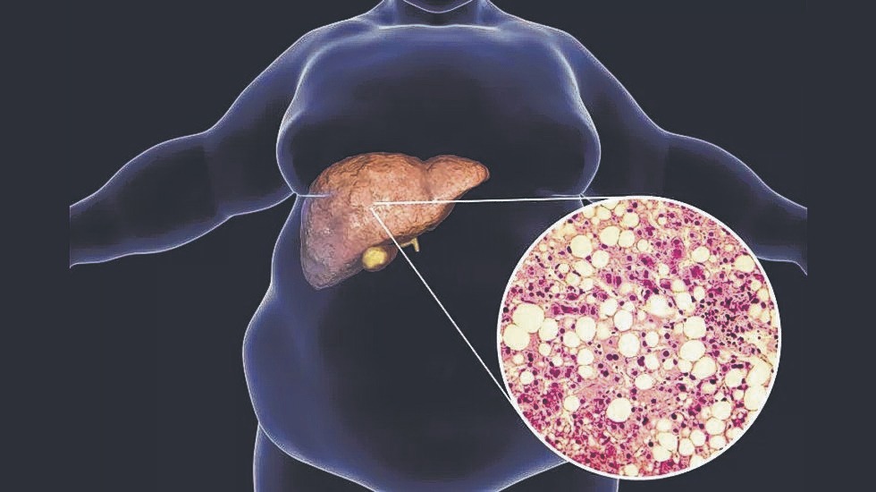  Evaluación de riesgo. El estudio se hizo con 238 pacientes  con hígado graso de la Argentina