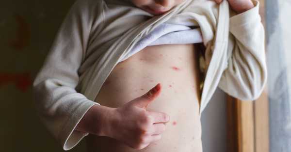 La varicela es una enfermedad infecciosa. Foto ilustrativa