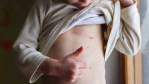 Detectaron un brote de varicela en un colegio de Bariloche