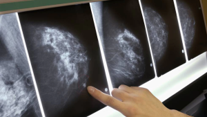 Un medicamento frena el cáncer de mama en el 75 % de los casos