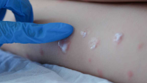 Viruela del mono: evalúan un segundo caso sospechoso en el país