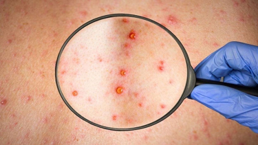 La viruela del mono se ha detectado en 50 países. 