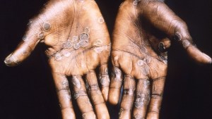 Viruela del mono: OMS confirma más de 1.000 casos y teme que se instale en países no endémicos