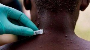 Lo que se sabe hasta ahora de la viruela del mono