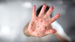 España detectó 59 casos de viruela del mono y anunció la compra de vacunas