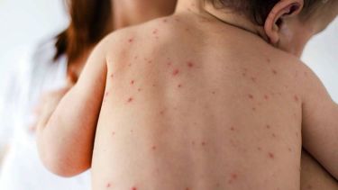 La niña presentó síntomas compatibles con la enfermedad y fue testeada.-