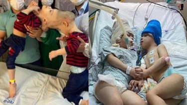 Niños siameses brasileños unidos por la cabeza fueron separados en una intervención que duro 23 horas.