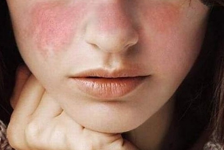 Los sarpullidos en la piel también pueden ocurrir por el desarrollo del lupus