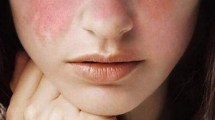 Imagen de Lupus: las cinco claves para cuidar la calidad de vida