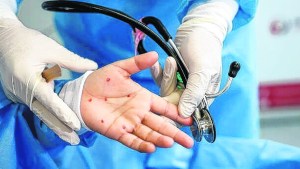 Los ojos, una clave de la viruela del mono