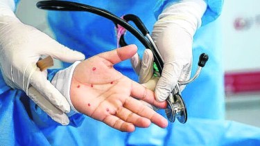 La viruela del mono sigue creciendo a nivel global. Es fundamental mantenerla controlada con consultas médicas.