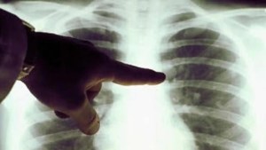 Día del cáncer de pulmón: prevención y detección temprana