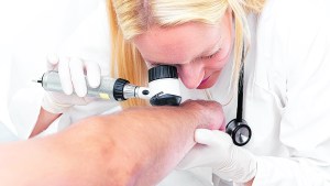 Cáncer de piel y su prevención