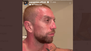 Papu Gómez y las consecuencias de haber estado expuesto al rayo del sol. 