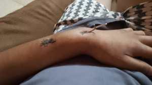 El suplicio de un joven en Bariloche: le dispararon y necesita una prótesis con urgencia