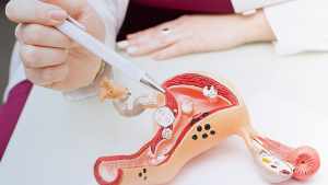 Endometriosis: en el Día Mundial, el testimonio de quienes «viven en desesperación» por padecerla