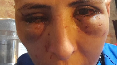 La mujer fue atacada brutalmente y corre riesgo la visión de uno de sus ojos. Foto: Centenario Digital