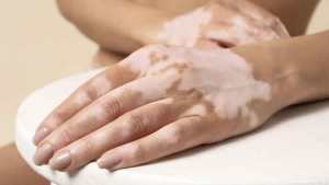 El riesgo de padecer depresión es cinco veces mayor en pacientes con vitíligo