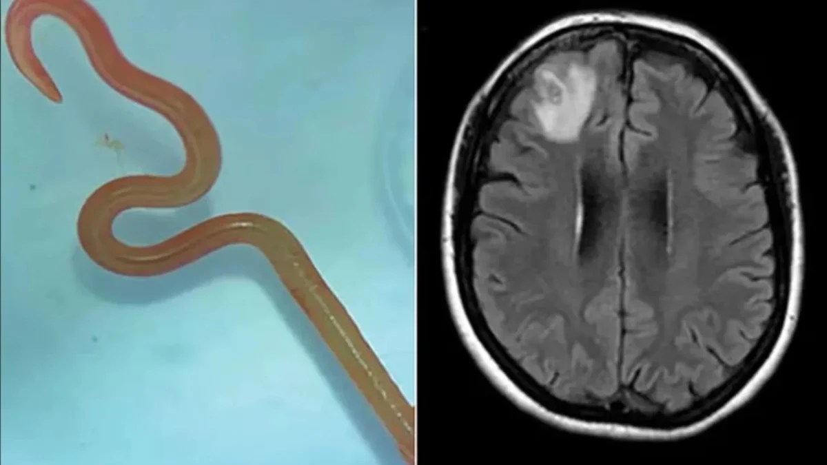 Médicos de Australia encontraron un gusano vivo en el cerebro de una paciente. 