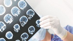 ACV: cada minuto cuenta