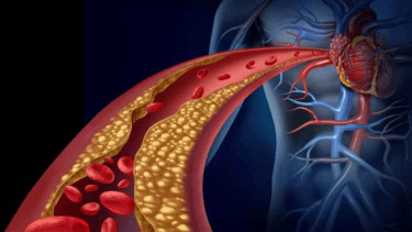 Colesterol: lanzan en Argentina un medicamento alternativo que no produce dolores musculares
