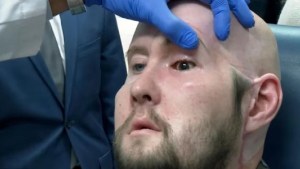Hito: se realizó el primer trasplante de ojo completo de la historia, en Estados Unidos