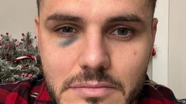 El argentino Mauro Icardi terminó con un golpe en el ojo en un clásico turco picante. 