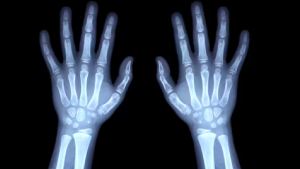 Calcular la edad con radiografías puede ser discriminatorio