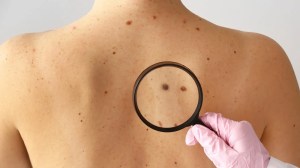 Hito en la medicina: la primera vacuna de ARN contra el cáncer de piel supera con éxito la fase final