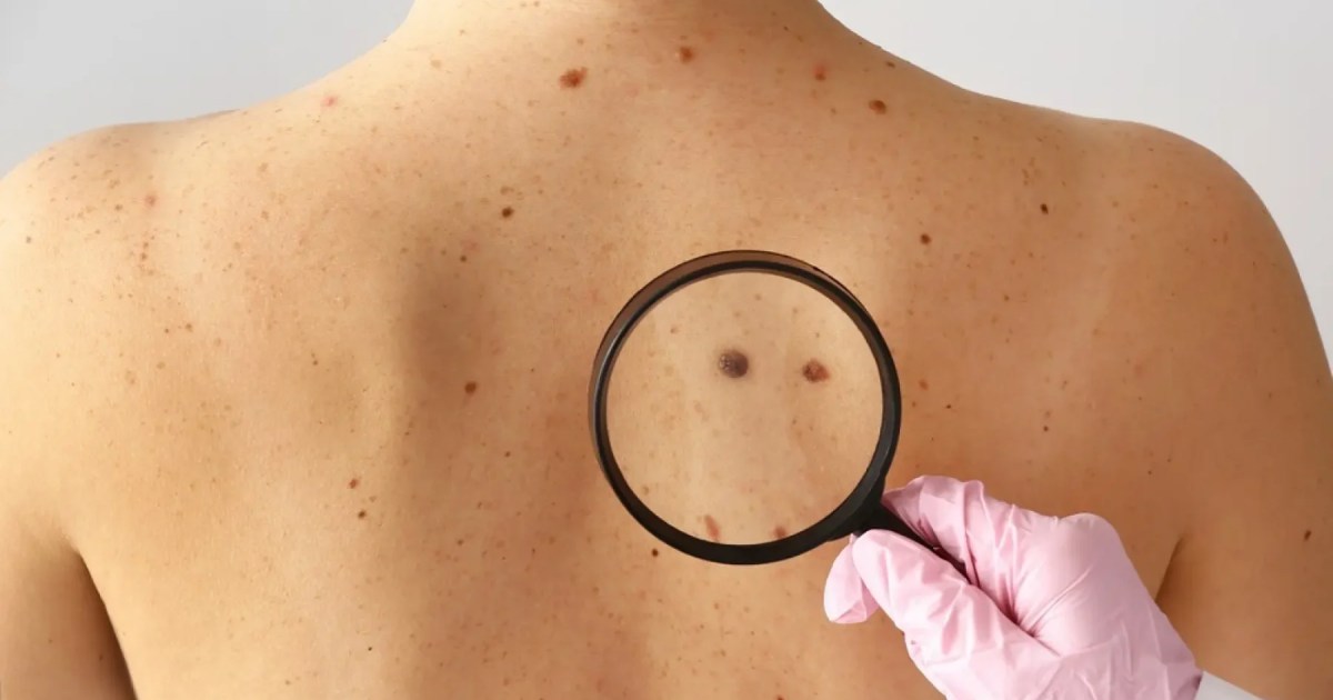 Hito en la medicina: la primera vacuna de ARN contra el cáncer de piel supera con éxito la fase final