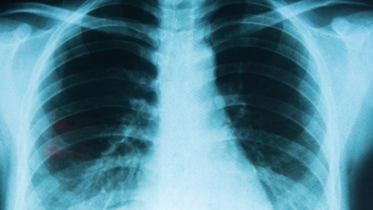 Aprobaron en Argentina un tratamiento contra el cáncer de pulmón. 