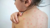 Imagen de Qué es el sarampión, cómo se contagia y qué medidas se pueden tomar para prevenir la enfermedad