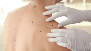 Aumentan los casos de melanoma en la Argentina: quiénes tienen más riesgo y cómo hacer un autoexámen de piel