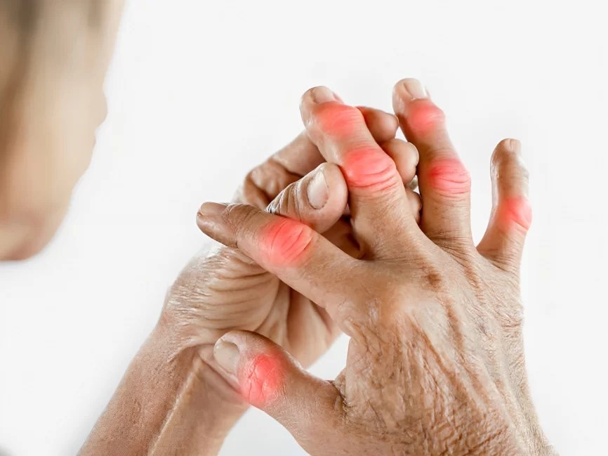 Artrosis y artritis: cuáles son las diferencias y cómo detectarlas