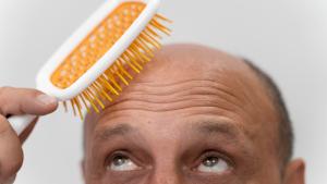 Trasplante capilar en Turquía: ¡El nuevo destino top para este procedimiento!