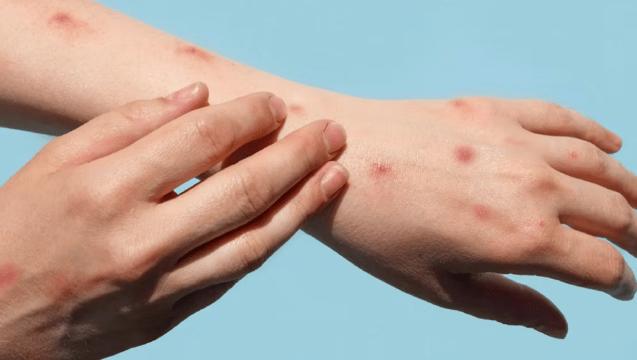 Confirman el primer caso de una variante más contagiosa y severa de la viruela símica. Foto: archivo.