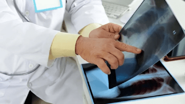 Tuberculosis en Neuquén: confirman un caso, se trata de una adolescente de El Chañar. 