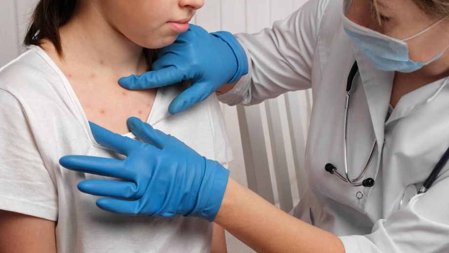 Alertan por aumento de casos de sarampión en el país. Foto: archivo.