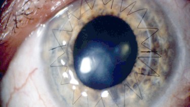 En un trasplante de córnea, un cirujano extrae la córnea dañada y la sustituye por la de un donante