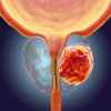 Imagen de La inteligencia artificial cambia el diagnóstico del cáncer de próstata: menos biopsias y más precisión